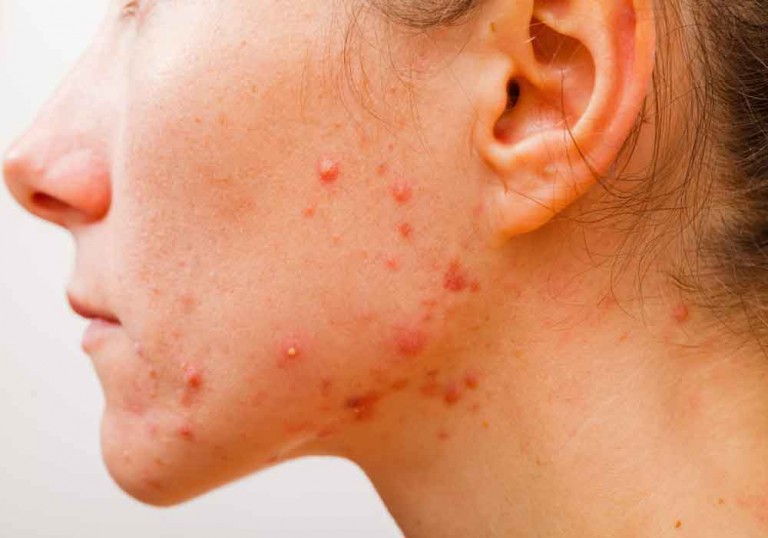 all-you-wanted-to-know-about-pimples-and-its-treatment