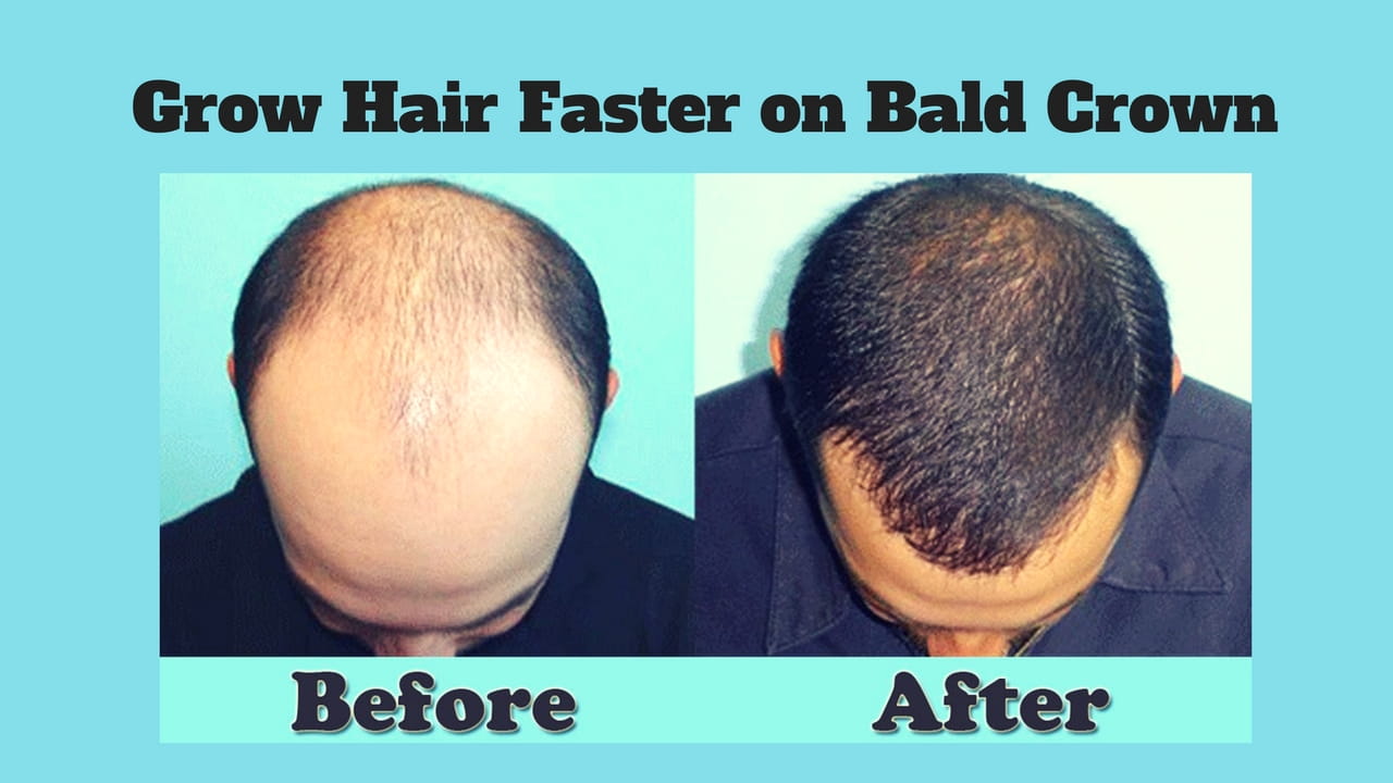 5 Ways to Help Your Hair Grow Faster when You Have a Bald Spot