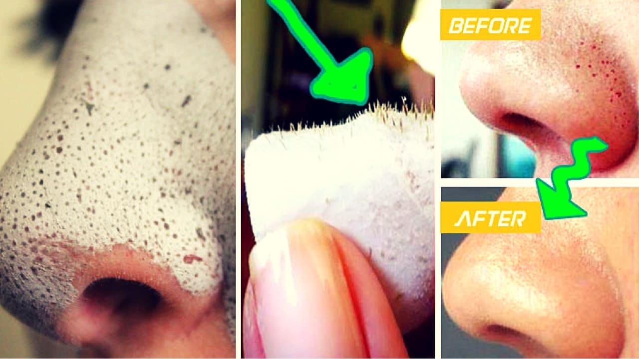 Tips To Remove Blackheads From Nose In 10 Minutes Medy Life