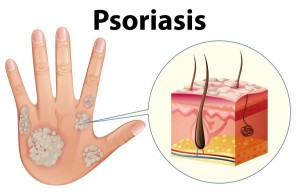 Psoriasis