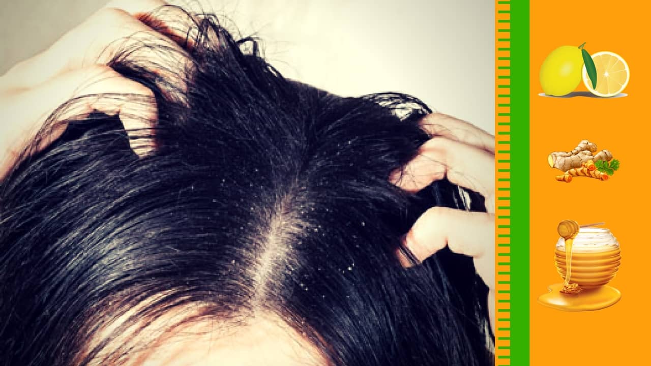 Quick Tips on How to Get Rid of Dandruff Naturally !