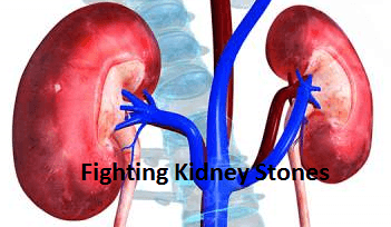 Fighting Kidney Stones