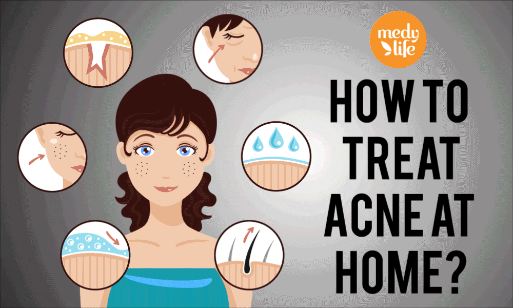 Acne: Types, Causes, Treatment & Home Remedies