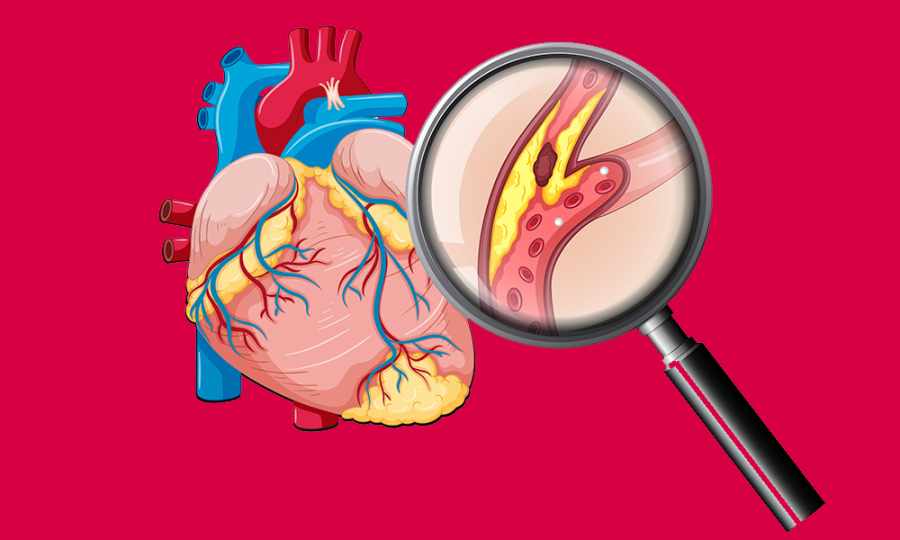 Types of Cholesterol | Book Lipid Profile Test in Indirapuram