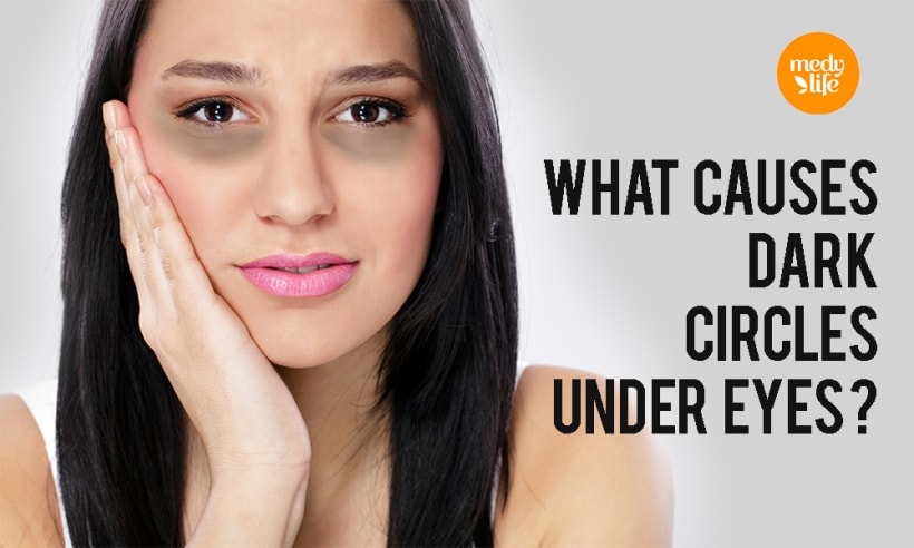 How to get rid of Dark Circles with Easy Home Remedies