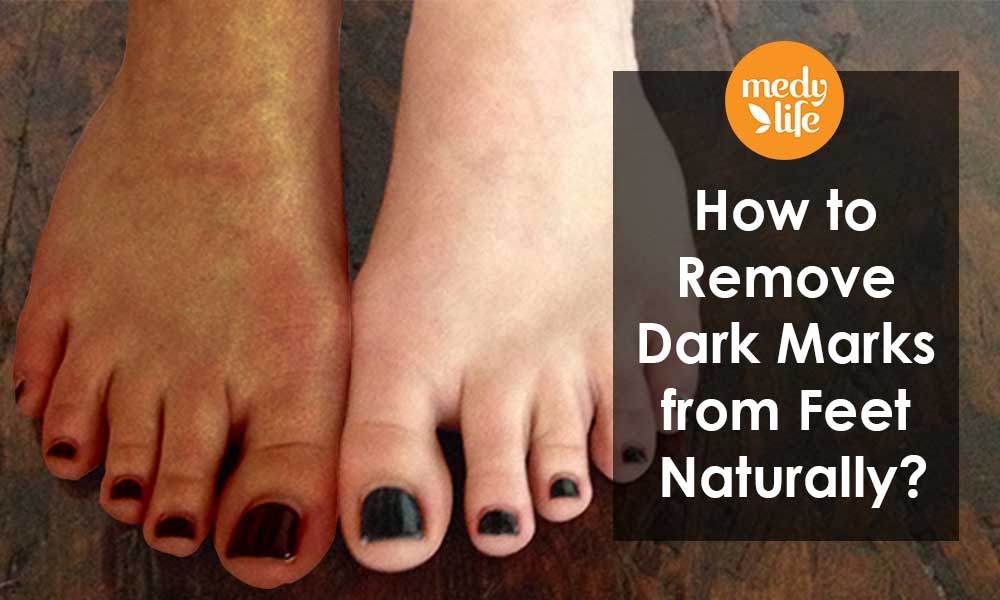 How to Remove Dark Marks from Feet Naturally?