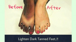 Remove Dark Marks on Feet