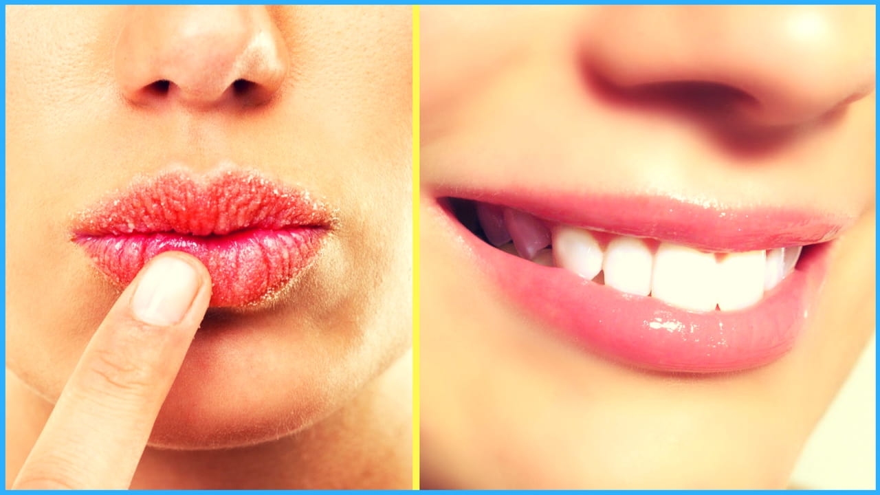 Effective Home Remedies for Dry and Chapped Lips