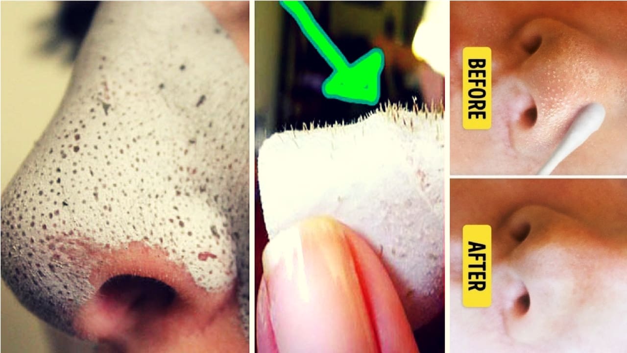 How to Get Rid of Whiteheads in 15 Minutes at Home?