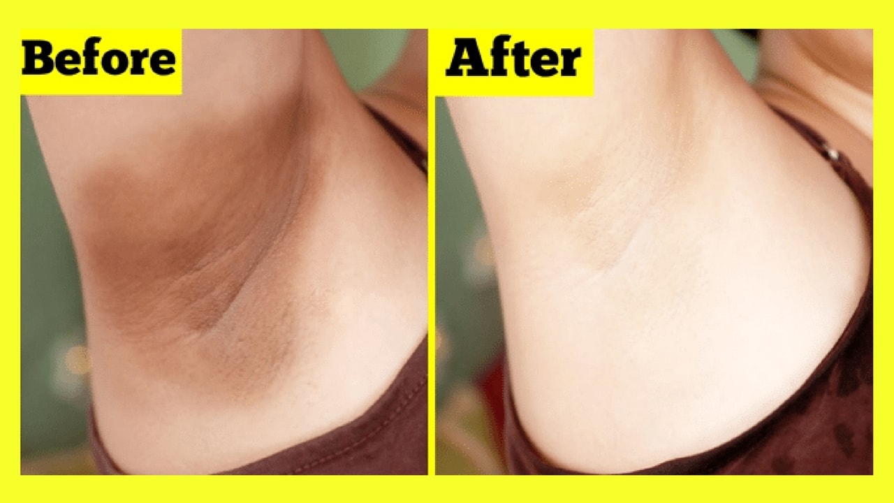 Top 10 Tips to Whiten Underarms in 20 Minutes